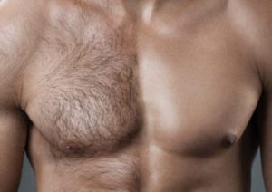 Востребована ли лазерная эпиляция у мужчин? Особенности ее проведения