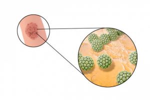 Последствия воздействия вируса папилломы человека
