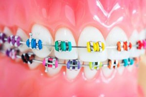 Установка лигатурных брекетов: особенности