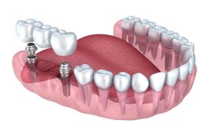 Самые лучшие зубные импланты