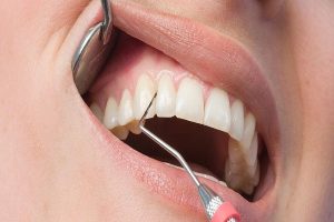 Лечение пародонтита десен: основные методы и рекомендации