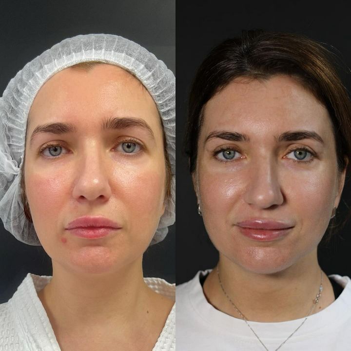 Фейслифтинг: современные подходы к омоложению лица