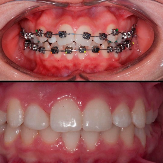 Лингвальные брекеты: эстетика и эффективность ортодонтического лечения