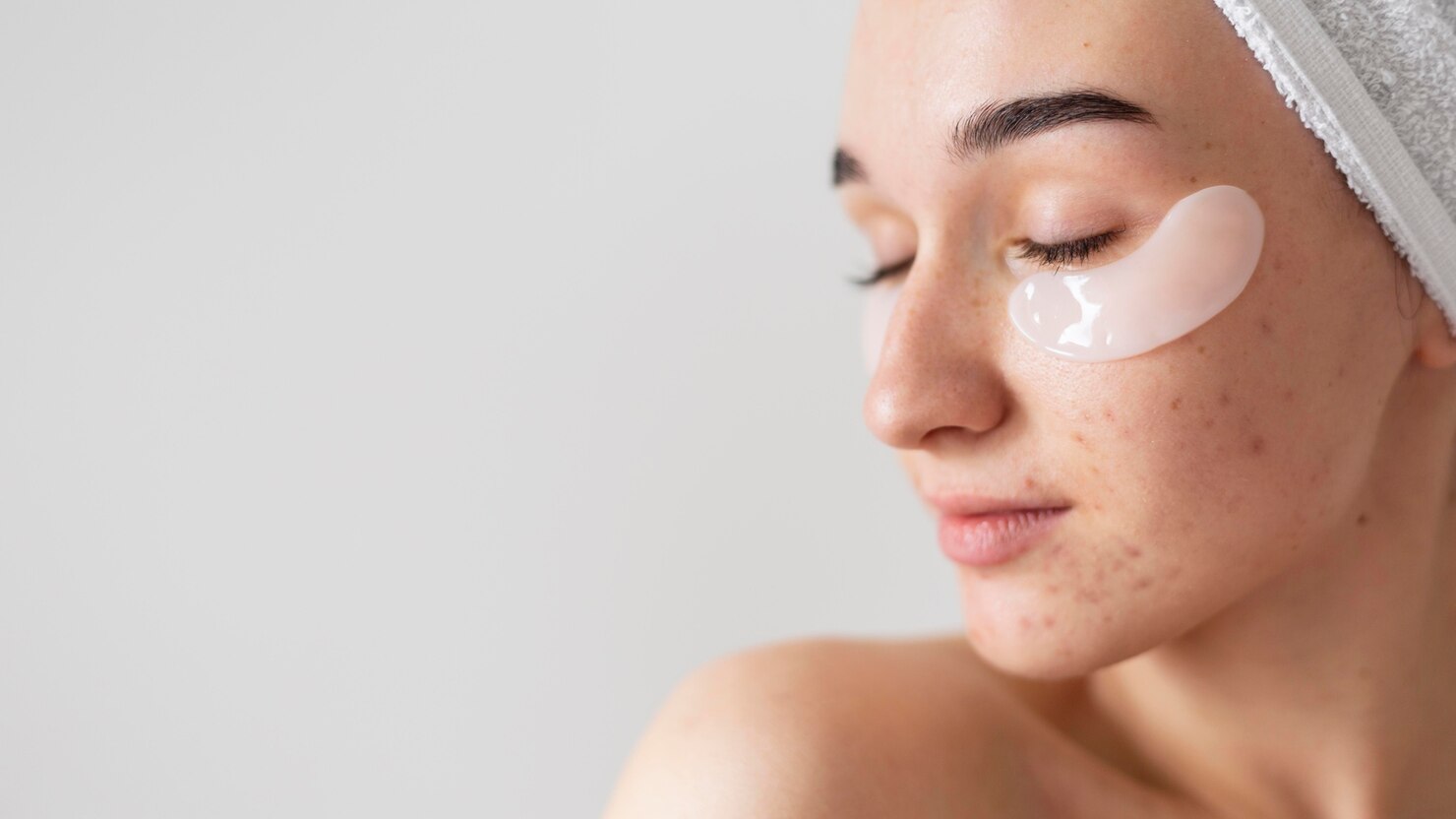 Как избавиться от постакне: практические советы