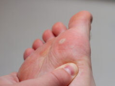 Стержневая мозоль: почему не помогает домашнее лечение и когда идти к подологу